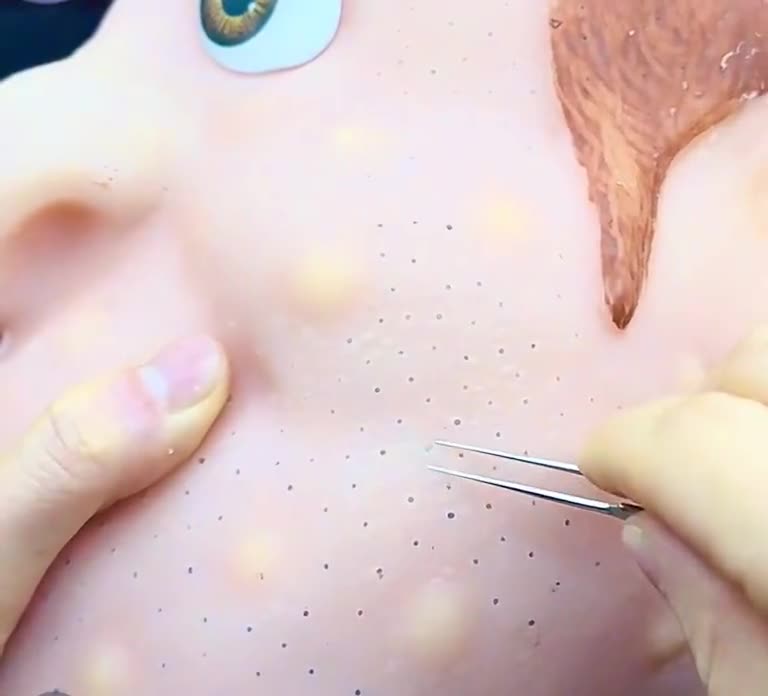 Blackhead Acne Squeezing Toy, Sensory Fidget, Stress Relief Gift